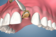 Immediate Implant Placement Lateral No Flap